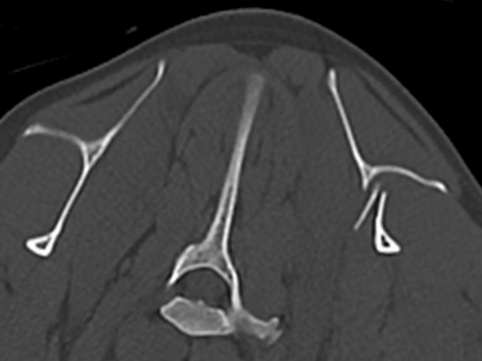 imgonline-com-ua-dexif2u8sV5DWMUK0 2. Axial CT showing the fractured scapula (shoulder blade) with bone fragment. Photo: © Chantry Vets